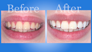 Abiwhitening
